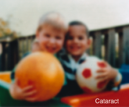 Vision loss caused by cataracts