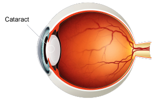 Human Eye with Cataract